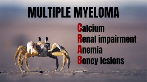 crab multiple myeloma|best multiple myeloma treatment centers.